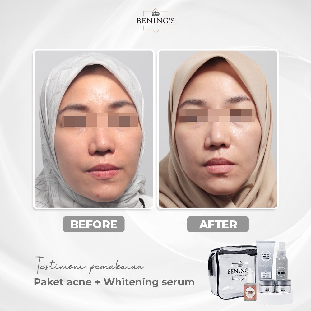 BENING SKINCARE by dr Okky Paket Acne Skincare FreeGift Cermin|Paketan jerawat dan beruntusan BENING CLINIC-1