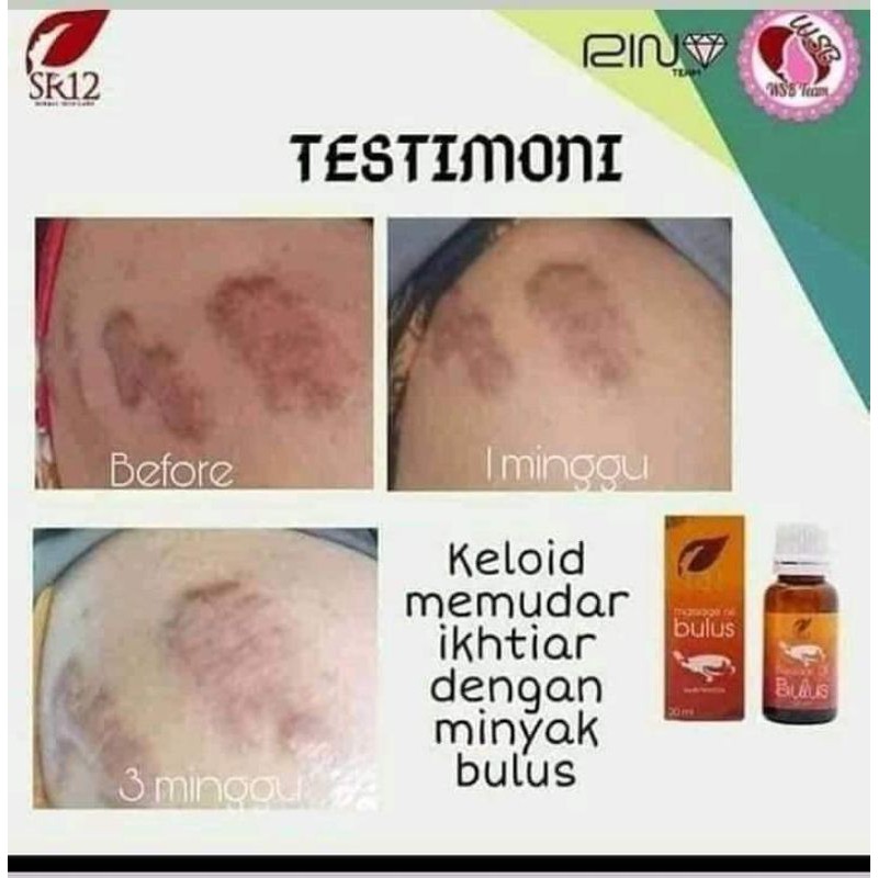 MINYAK BULUS SR12 OBAT GATAL KULIT DAN PEMUDAR BEKAS LUKA