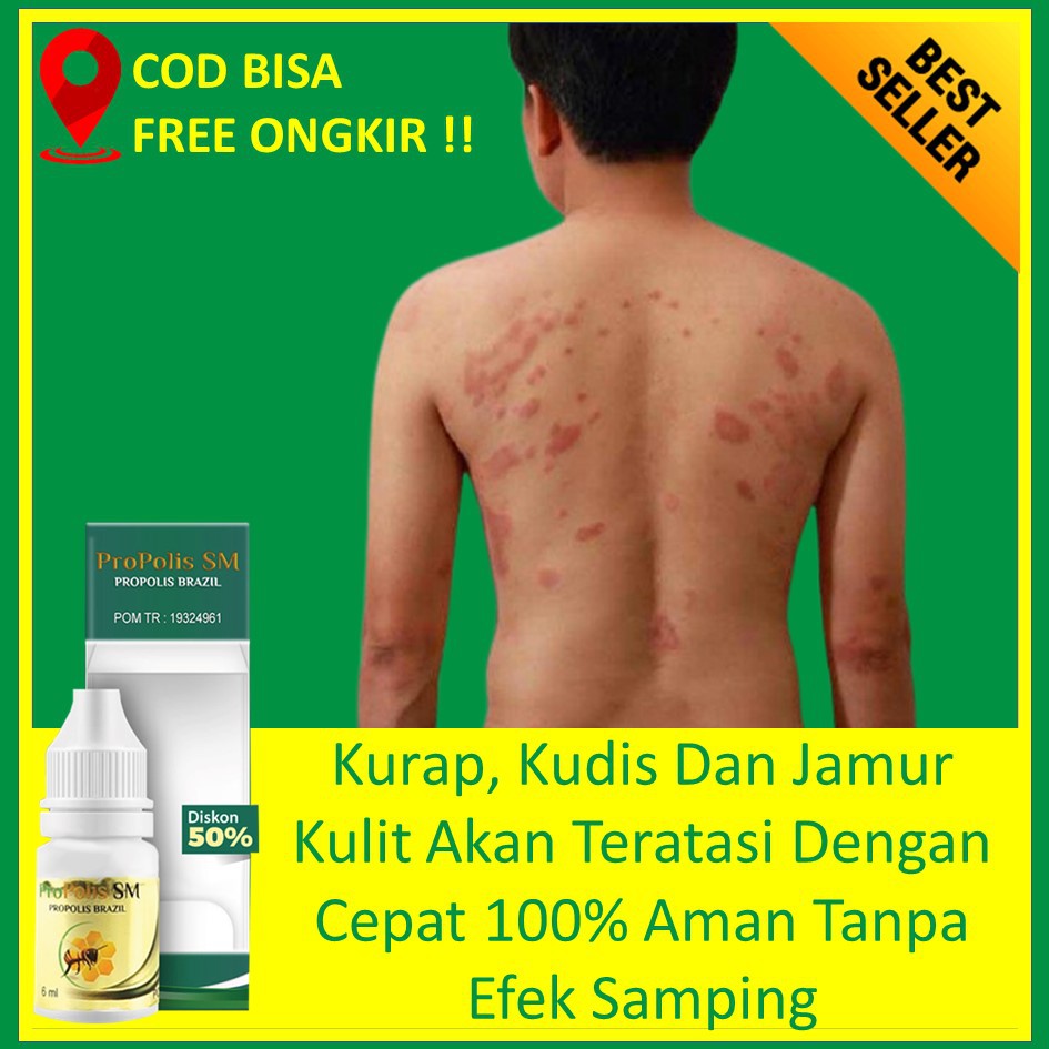Obat Kulit Gatal Gatel Kurap Kudis Kadas Aman Untuk Anak Dan Dewasa Dengan Propolis Sm Shopee Indonesia