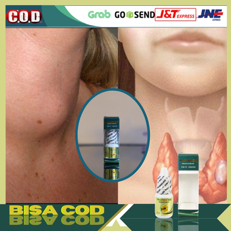 

Propolis SM BRAZIL Obat Tiroid Bengkak, Tiroid Kelenjar Di Leher
