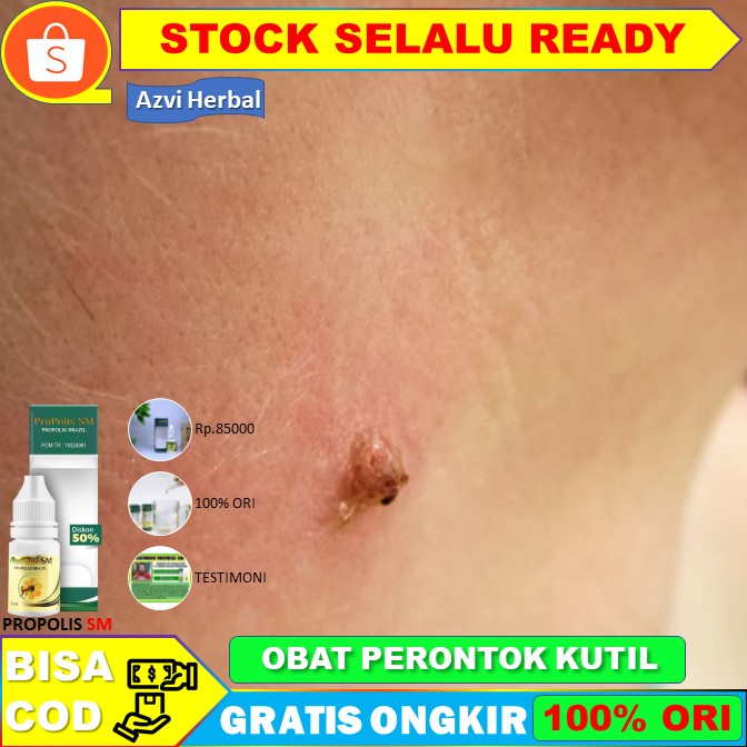 Obat Papiloma, Penghilang Papiloma, Penghilang Kutil, Papiloma di Leher dan Wajah - Propolis SM