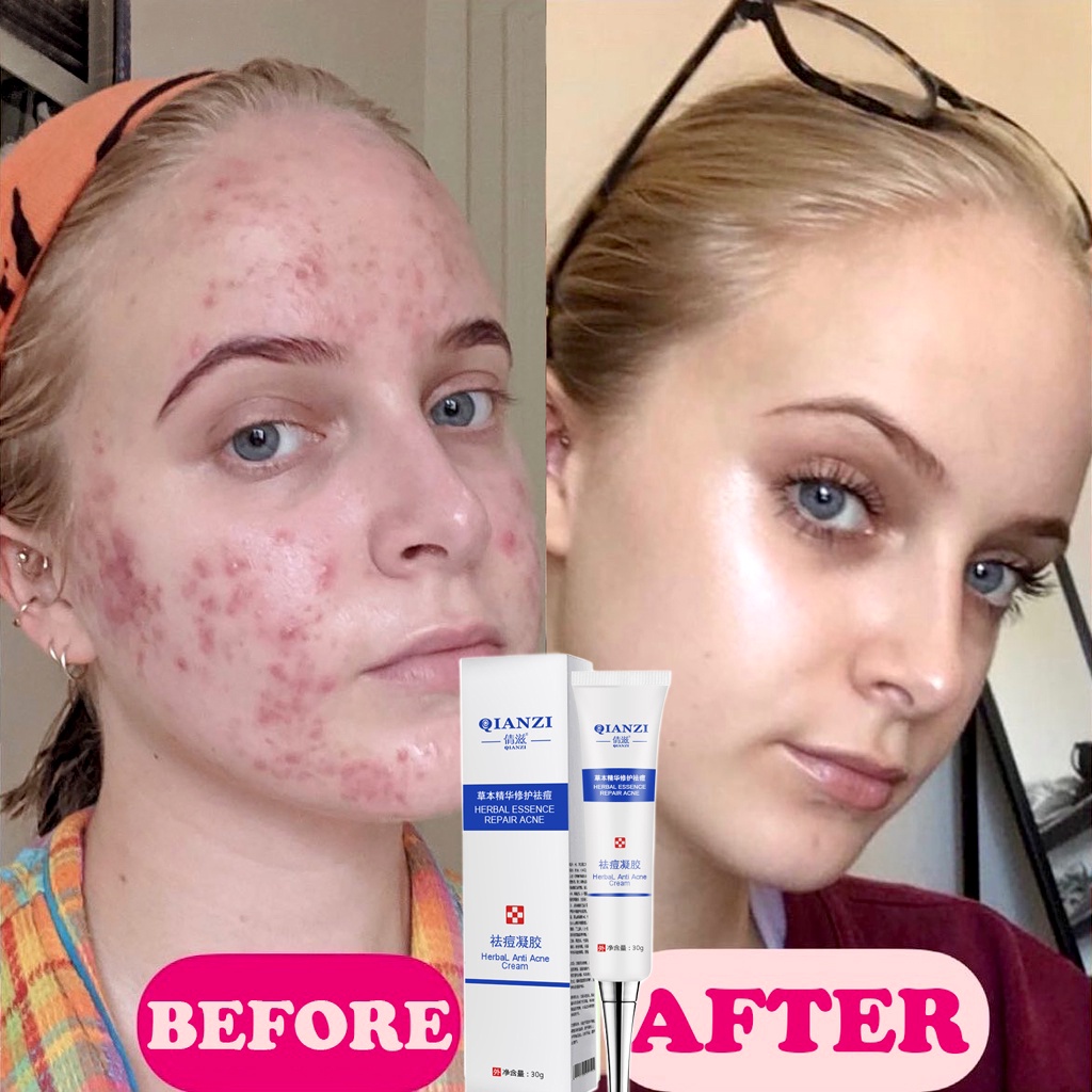 Jual Cream jerawat Treatment jerawat gel 30g Rapid acne removal spot care Shopee Indonesia