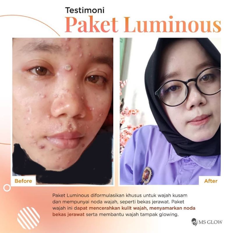 Ms Glow Paket Luminous Free Pouch | Paket Luminous Ms Glow