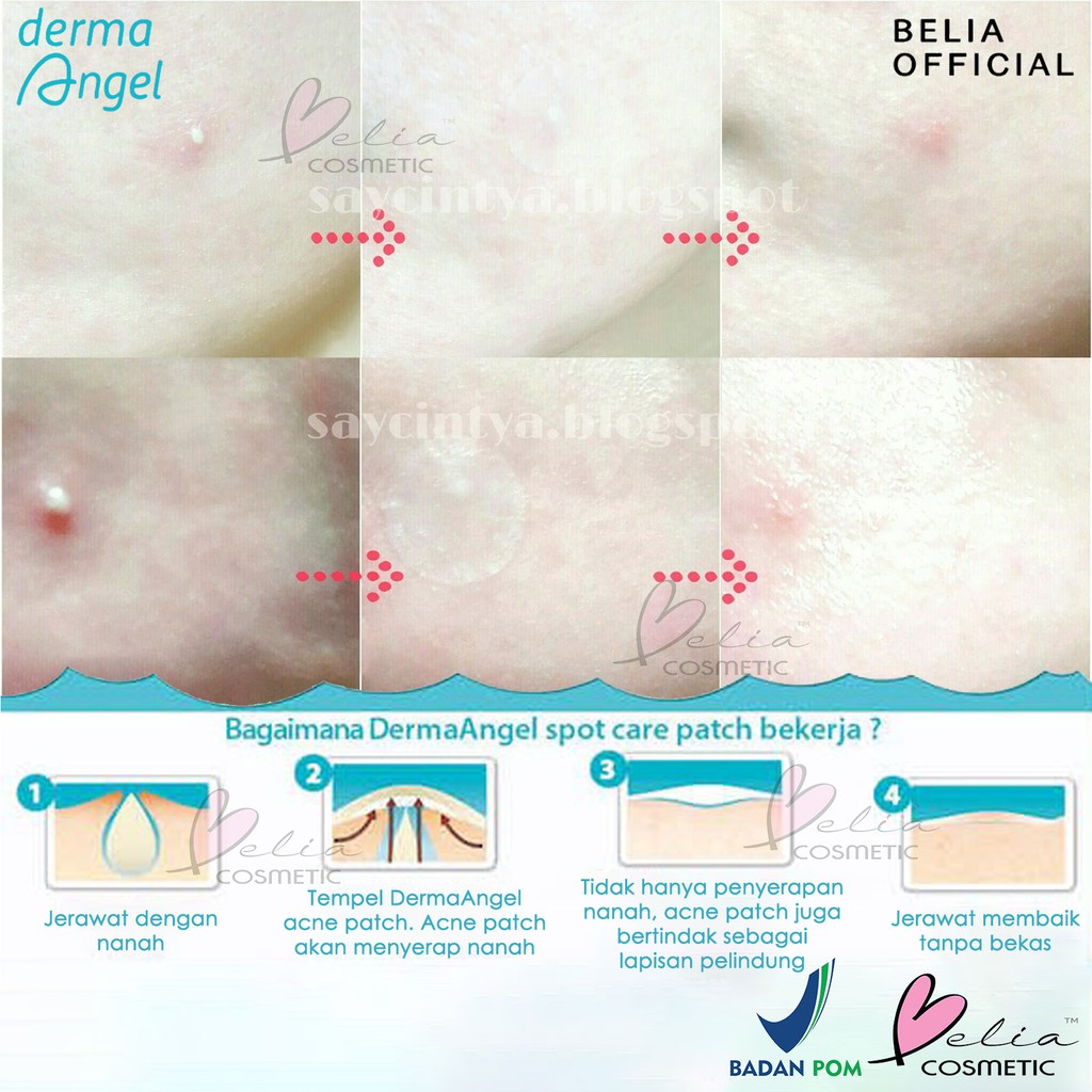 ❤ BELIA ❤ DERMA ANGEL (✔️BPOM)  Acne Patch Day Night | Plester Jerawat Transparan | Intensive Gel With Salicylic Acid