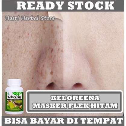 Obat Penghilang Kokoloteun, Flek Hitam di Wajah, Masker Menghilangkan Bercak Atau Flek Plek Hitam Di Muka, Pembersih Noda Coklat di Muka, Melasma Menahun, Mengatasi Wajah Kokoloten Akibat Sinar Matahari, Meratakan Warna Kulit Dengan Keloreena