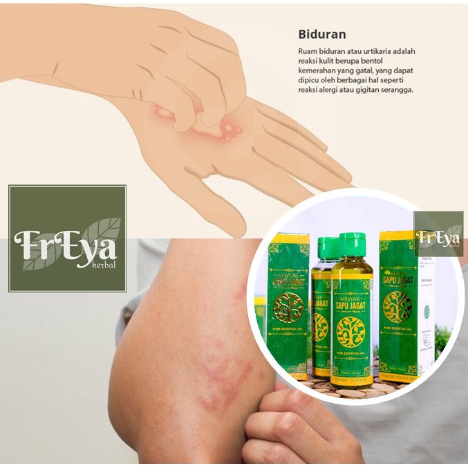 OBAT KALIGATA, OBAT HERBAL BIDURAN, OBAT URTIKARIA, OBAT BIDURAN AKUT, OBAT BIDURAN KRONIS (BISA COD