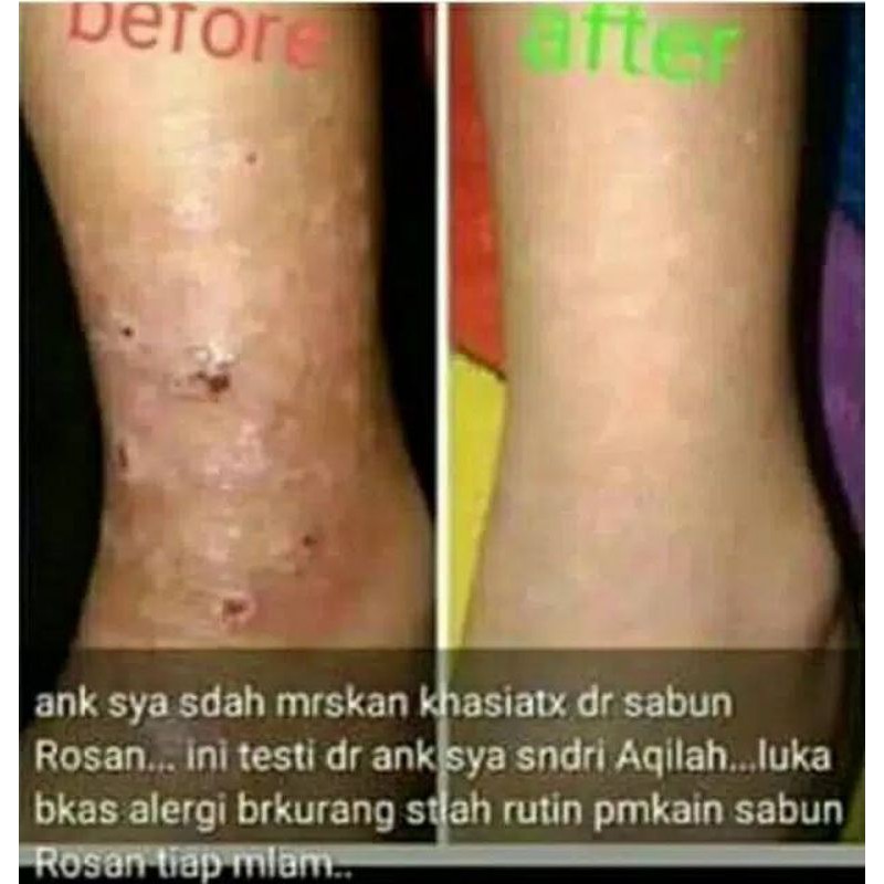 Sabun Rosan Beauty Kesehatan Kecantikan Glowing Anti Jerawat Alergi Aroma Mawar