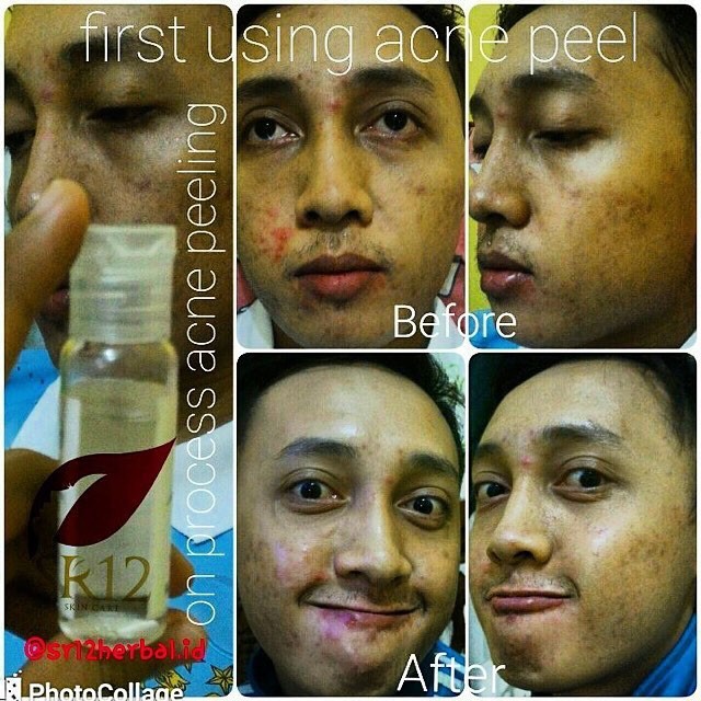 CHEMICAL PEELING ACNE SR12 - ACNE PEEL SOLUSI BOPENG SCAR BHA 30% HILANGKA BEKAS JERAWAT dan bruntus