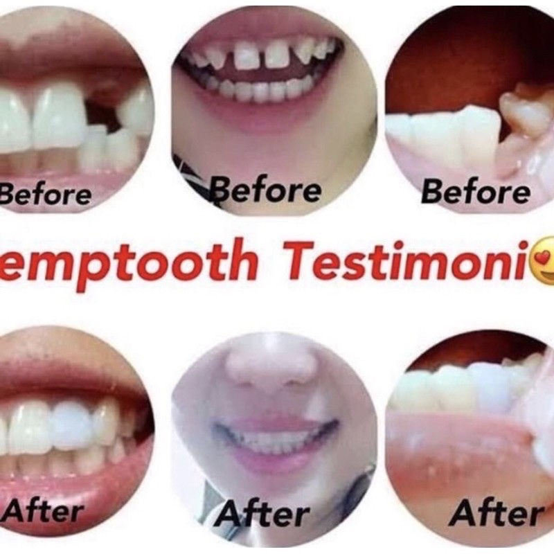 TERMURAH !! 1000 BUTIR TEMPTOOTH GIGI PALSU SEMENTARA PENAMBAL GIGI PATAH RENGGANG / TEMTOOTH / BAHAN TAMBAL GIGI BOLONG BERLUBANG / TEMPORARY TOOTH INSTAN PRAKTIS / TEMPTOOTH GINGSUL PATAH LEM TIRUAN MURAH ORIGINAL ISI 200 / 500 / 400 / 150 / 100 BUTIR