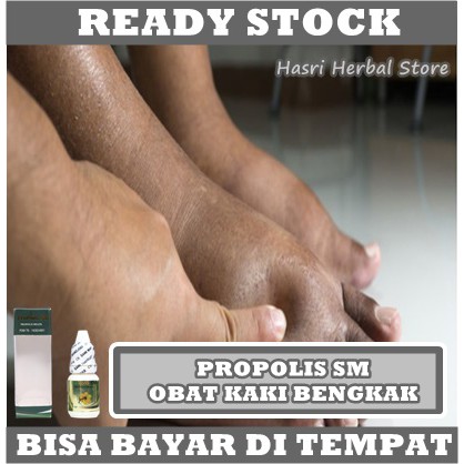 Obat Kaki Bengak Karena Jatuh - Asam Urat - Diabetes - Jantung - Ginjal, Obat Bengkak Pada Kaki, Obat Kaki Bengkak, Solusi Mengempiskan Kaki Bengkak, Obat Sembuhkan Kaki Bengkak, Obat Kaki Bengkak Susah jalan, Obat Nyeri Kaki Bengkak Dengan Propolis SM