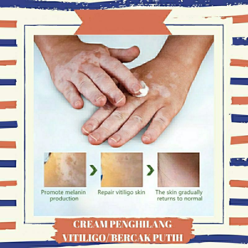 Original Sumifun Penghilang Vitiligo Salep Cream Vitiligo Bintik Putih