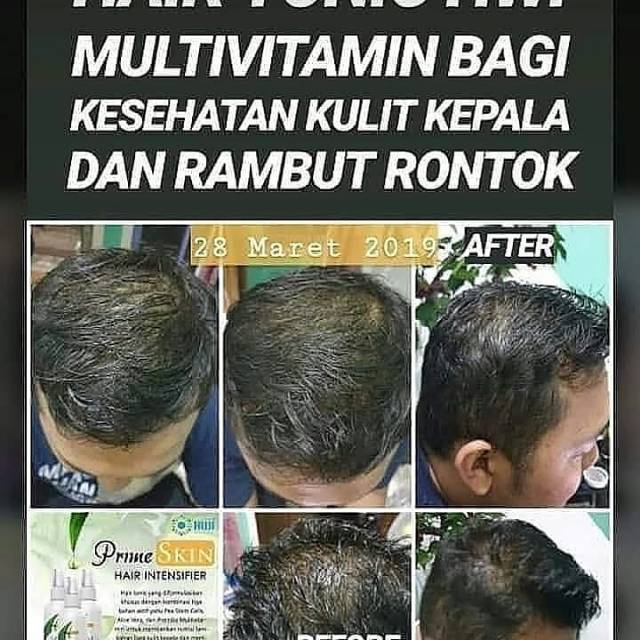 Menumbuhkan rambut, mengatasi kerontokan.