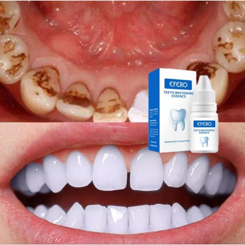 EFERO PEMUTIH GIGI/EFERO TEETH WHITENING