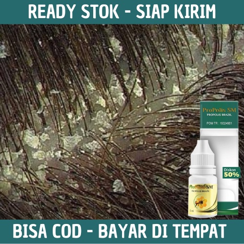 Obat Ketombe - Obat Ketombe Rambut - Penghilang Ketombe - Ketombe Kering - Ketombe Basah - Ketombe R