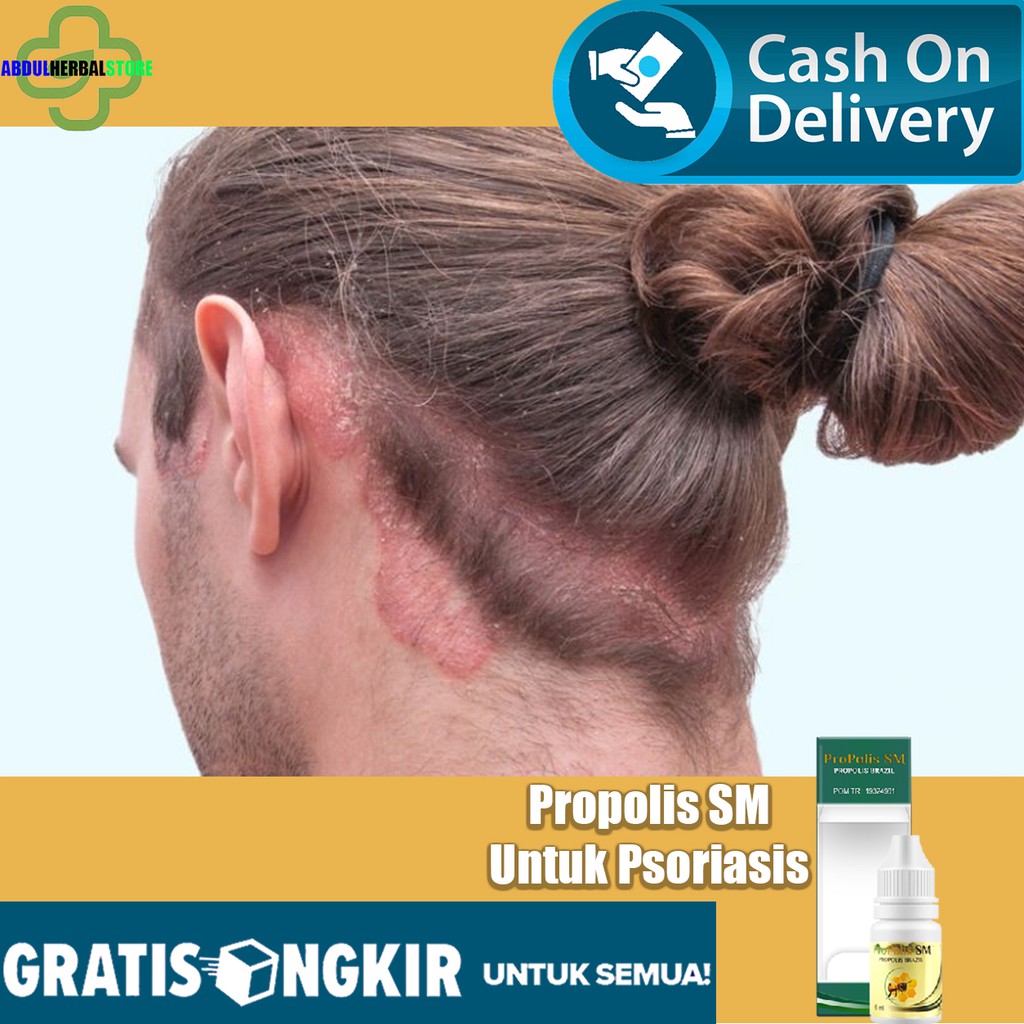 Obat Psoriasis Kulit Berkerak, Obat Kulit Kepala Gatal Parah, Obat Gatal Kulit Kepala, Propolis SM