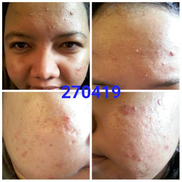 Serum acne