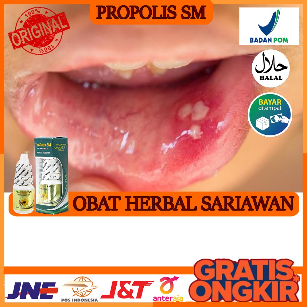 Jual Obat Alami Sariawan Gusi Berdarah Gusi Bengkak Gigi Berlubang Obat Herbal Propolis Sm Bisa Cod Indonesia Shopee Indonesia