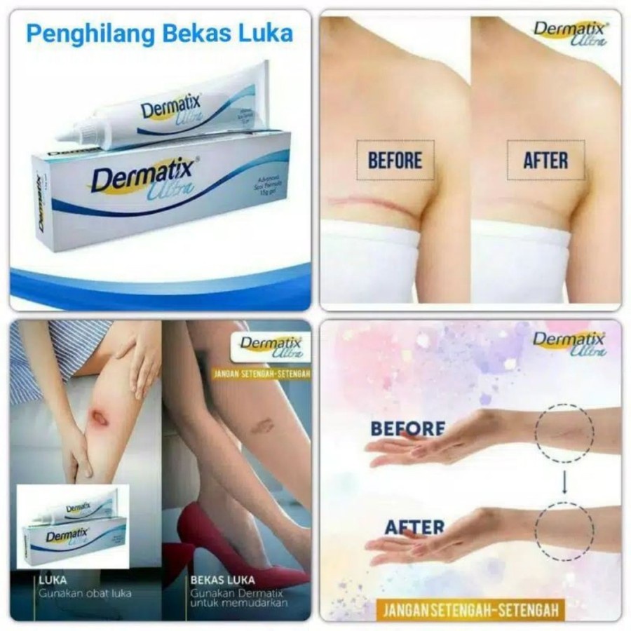 Dermatix Ultra Obat Penghilang Bekas Luka Salep Bekas Luka 15gr