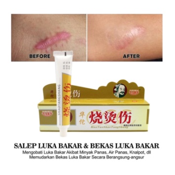 [ BAYAR DITEMPAT ] SALEP CREAM HUATUO SHAO TANG SHANG SALEP HERBAL CINA OBAT LUKA BAKAR PENGHILANG BEKAS LUKA Huatuo Salep Herbal Obat Luka Bakar &amp; Kena Air Panas Minyak Panas Kulit Melepuh Ampuh ORIGINAL ASLI SALEP AMPUH MENGOBATI KULIT MELEPUH