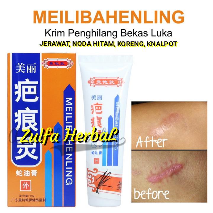 Dsc Derma Scar Penghilang Bekas Luka Bopeng Keloid 2pcs 