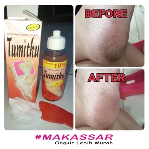 TUMITKU ORIGINAL Obat Kaki Pecah Ampuh Mengatasi Tumit Pecah COD