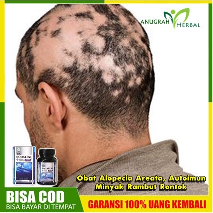 Apa itu penyakit alopecia areata