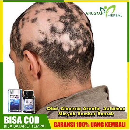 Alopecia penyakit apa