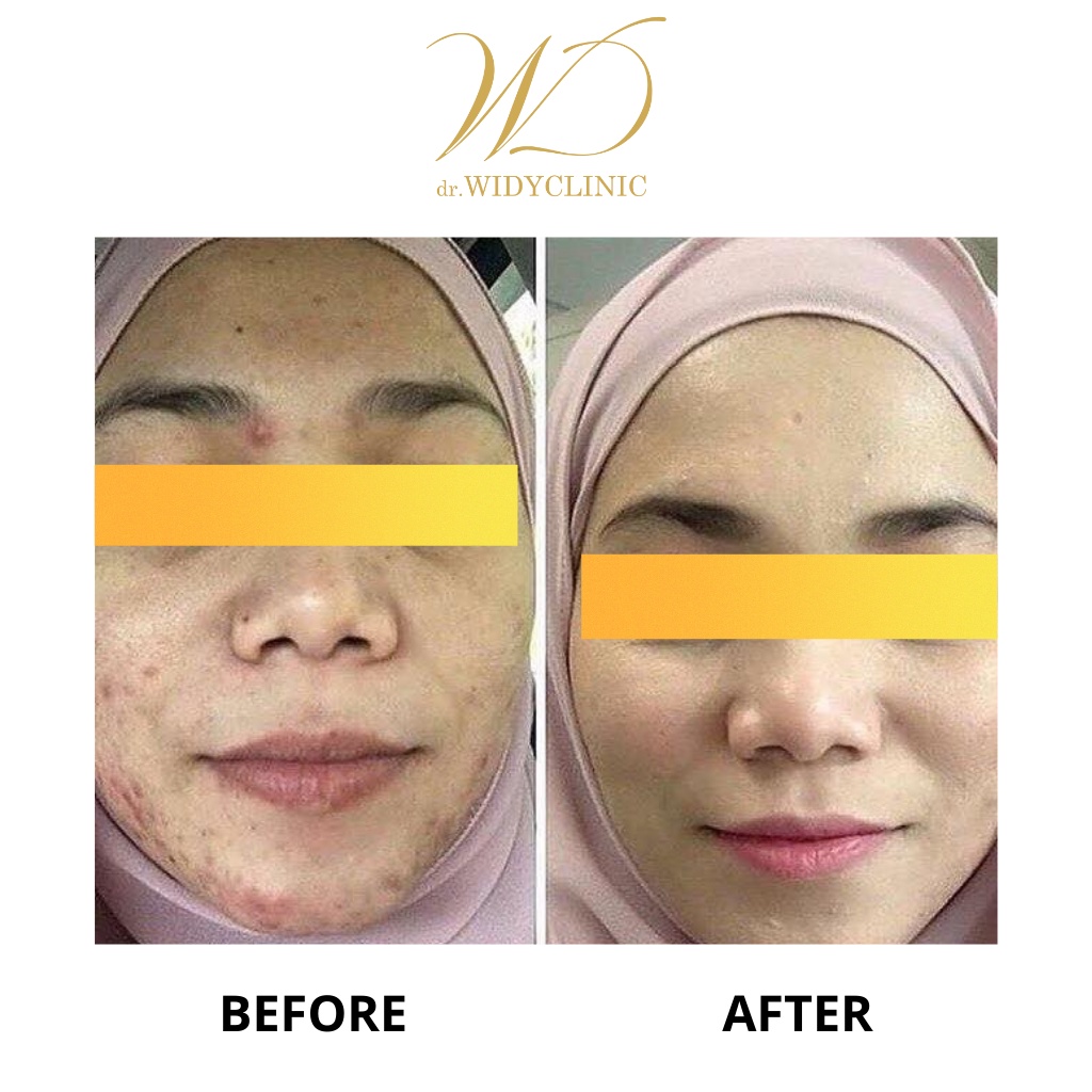 Acne Night Cream dr Widy Clinic Krim Jerawat Malam Glowing Mencerahkan BPOM Halal MUI Cream Untuk Semua Jenis Kulit &amp; Fungal Acne / Obat Jerawat Formulasi Dokter