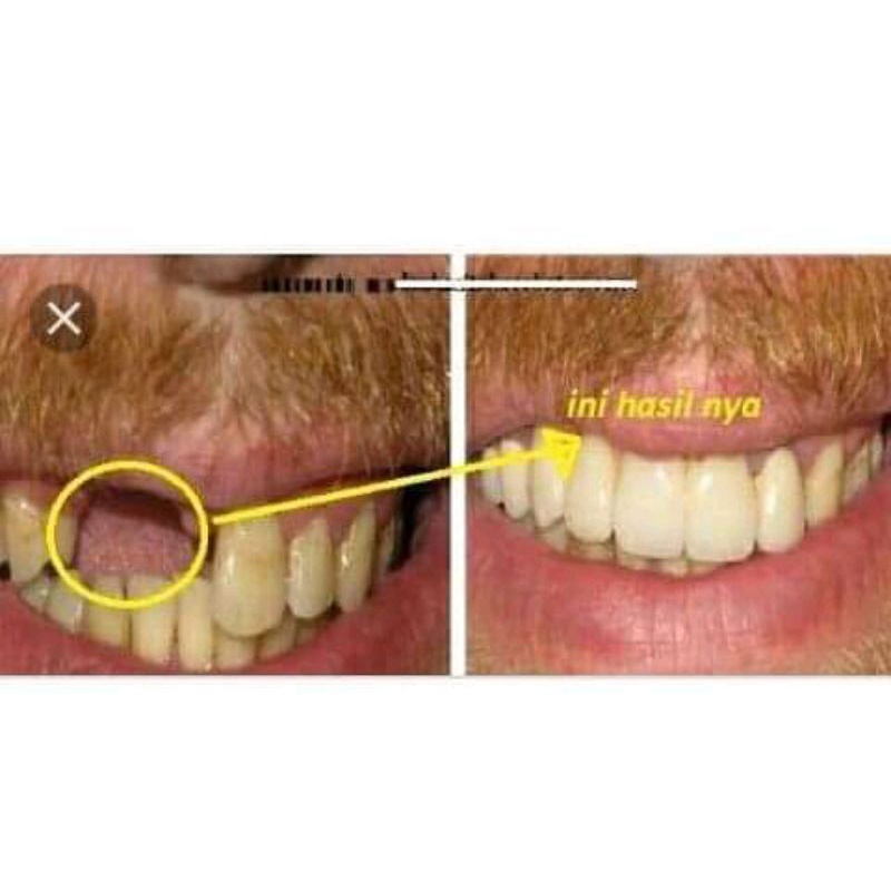 SUPLEMEN Obat Gigi Gigi berdarah Gigi Goyang Gigi rusak  Gigi keropos Gusi Bengkak Penumbuh gigi amp