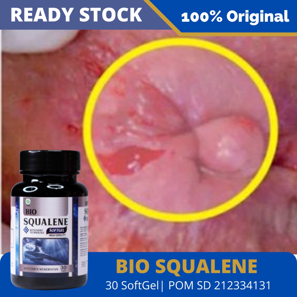 Obat Ambeien, Obat Herbal Ambeien, Obat Wasir Dan Ambein, Obat Stadium 3 4, Obat Ambein Menahun, Obat Anus Keluar, Nyeri Dubur, BAB Berdarah, Susah BAB, Benjolan Di anus, Obat Ambeien Wasir – Bio Squalene 100% Original BPOM