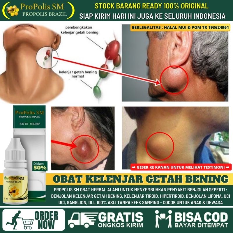 Obat Herbal Kelenjar Getah Bening Untuk Anak & Dewasa - Obat Benjolan di Leher, Benjolan di Bawah Da