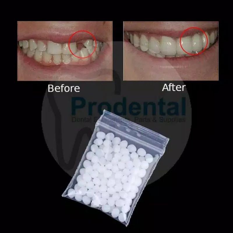 Penambal Gigi 2g - Temptooth Gigi Palsu 2g - Temporary Tooth Repair Kit Denture Teeth 2g