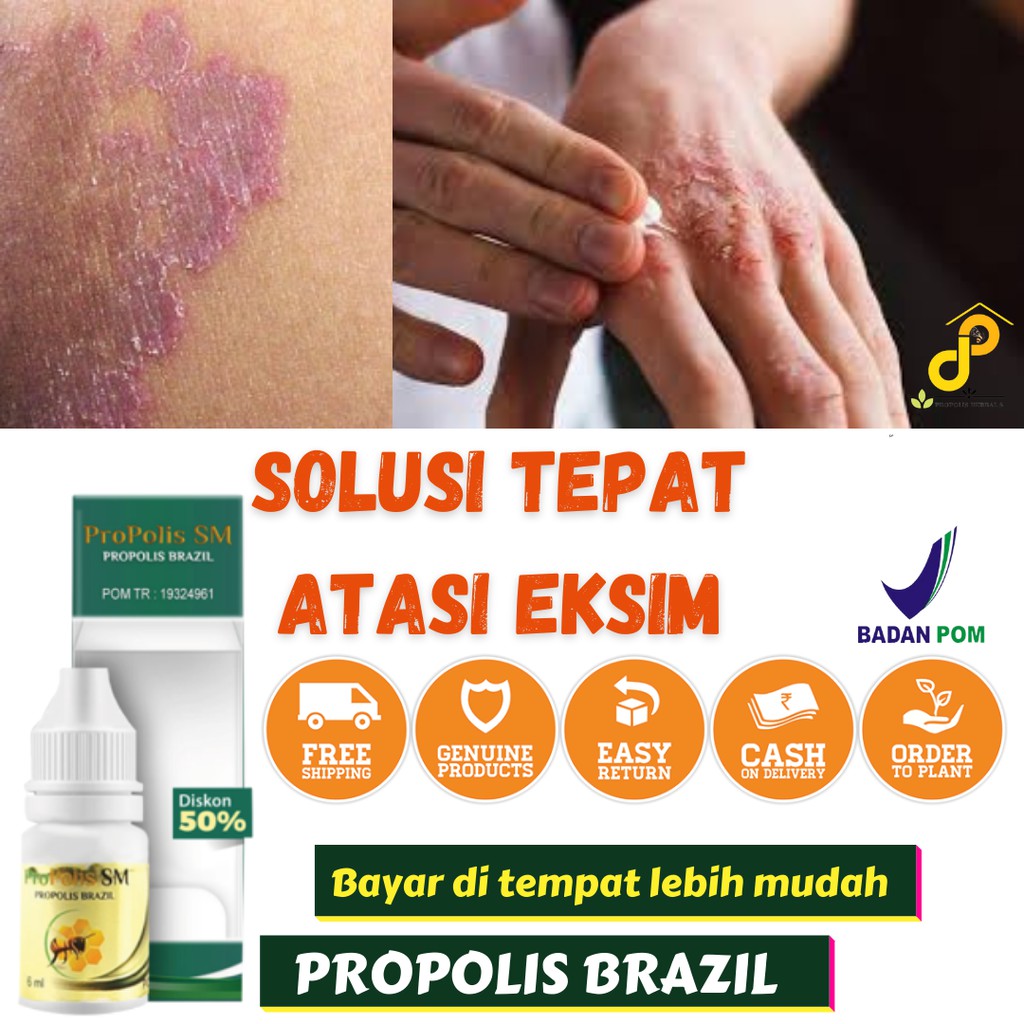 Propolis Obat Gatal Eksim, Obat Kulit, Obat Gatal Herbal, Obat Exim paling, Obat oles eksim di apoti