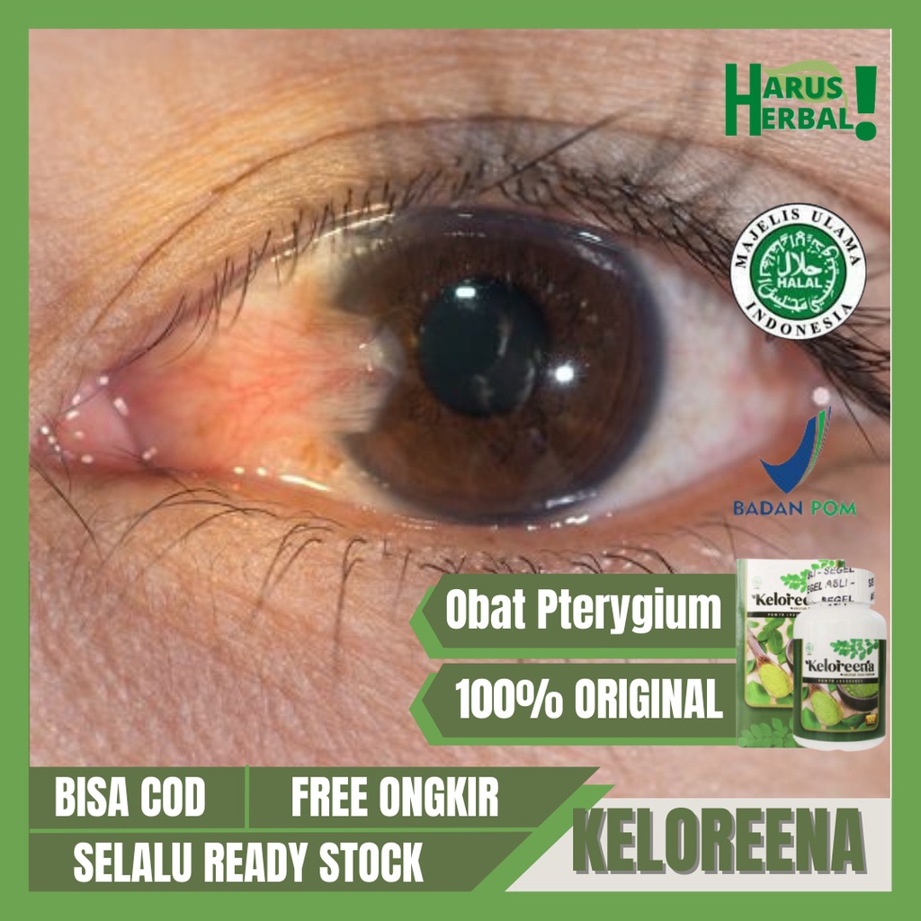 Obat Mata Pterygium, Obat Mata Berlemak, Obat Penghilang Lemak Mata, Obat Mata Kuning, Obat Menghila