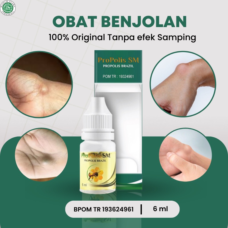 Propolis SM - Obat Benjolan di tangan, Obat Benjolan lipoma, Obat Kista ganglion, Obat Penghilang be