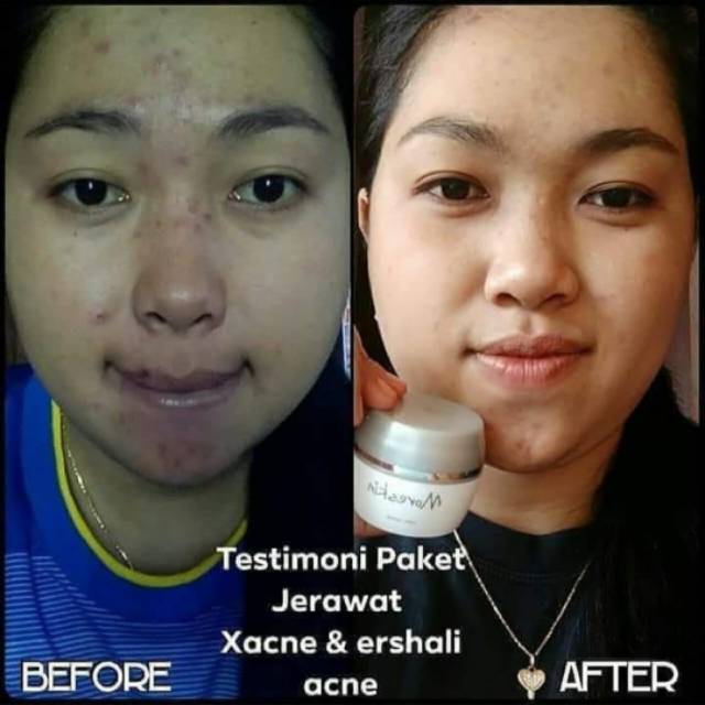 Moreskin anti acne