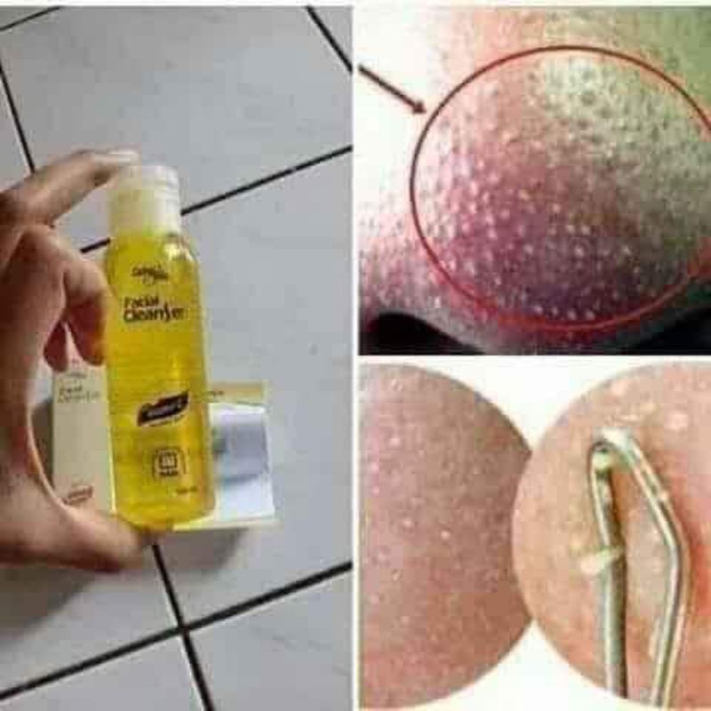 cofc ampuh untuk mengatasi komedo