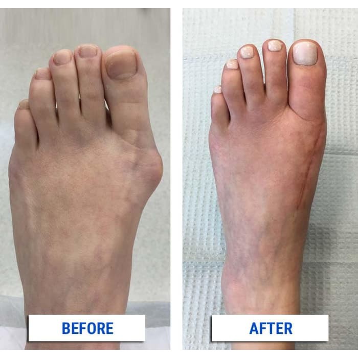 ALAT TERAPI JEMPOL KAKI BUNION PAD PELURUS JEMPOL KAKI, HALLUX VALGUS SPLINT