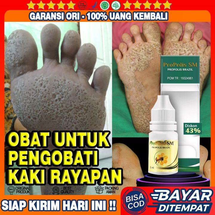 Obat Rayapan, Obat Penghilang Rayapan, Obat Kaki Rayapan, Obat Penghilang Kaki Bolong Alami Propolis
