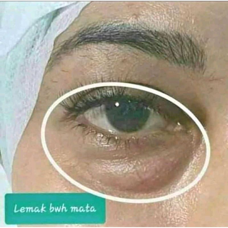 TERLARIS PENGHILANG MATA PANDA,KANTUNG MATA & KELOPAK HITAM