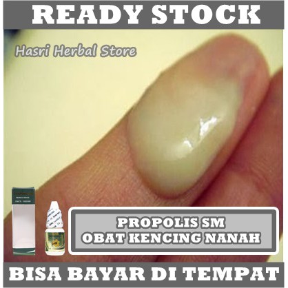 Obat Kencing Nanah Pria, Obat Kencing Sakit, Obat Kencing Berdarah, Obat Kencing Nanah Herbal, Obat Sipilis Paling Alami, Obat Sipilis Pria, Obat Sipilis Wanita, Obat Gonore, Obat Raja Singa, Dengan Herbal Propolis SM 100% Original BPOM HALAL