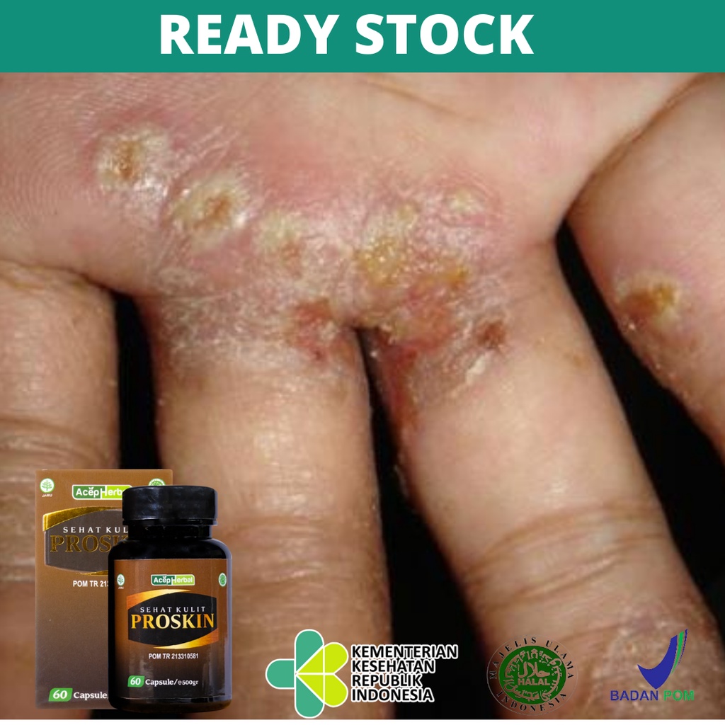 Obat Borok Bernanah, Obat Borok Menahun, Obat Pengering Luka Basah Borok, Amis Daging, Obat Untuk Me