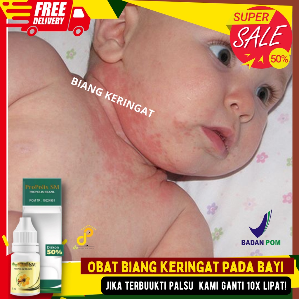 Obat biang keringat pada bayi biang keringat di kepala bayi biang keringat di wajah bayi kulit bayi 