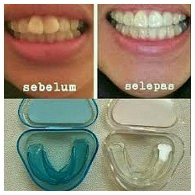 Perapi Gigi Teeth Trainer Rapatkan Gigi Tonggos Renggang Jarak Maju / Gusi