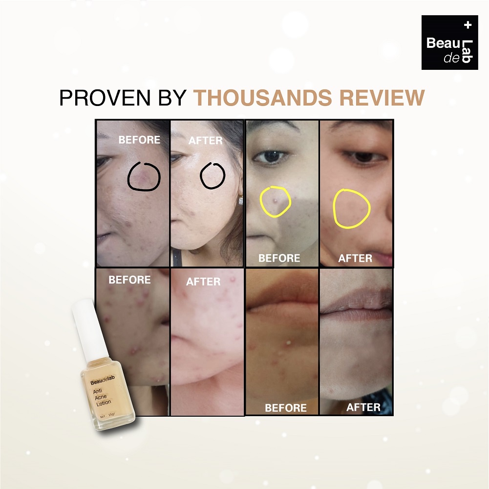 Beaudelab Obat Jerawat | Acne Serum | Acne Concealer | Acne Spot Treatment | Obat totol Jerawat | Penghilang Bekas Jerawat-1