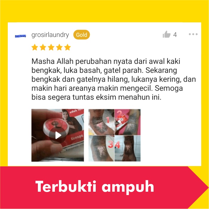 Salep Obat Gatal Eksim Kering Menahun Paling Ampuh Kulit Gatel Exim Basah Saleb Selangkangan Kurap Kutu Air Luka Diabetes Panu Kudis Kadas-2