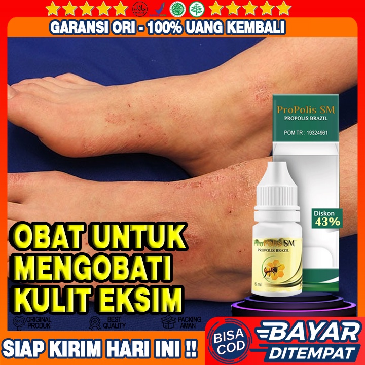 Obat Eksim, Obat Gatal Eksim, Obat Gatal Gatal, Obat Ruam Kulit, Obat Eksim Kering, Obat Eksim Basah