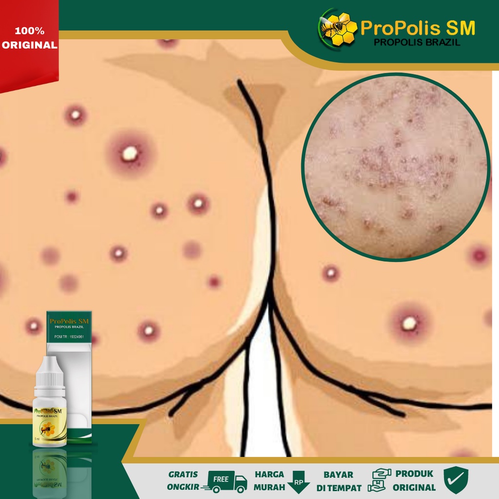 Obat Bruntusan Di Pantat/Bokong, Obat Pantat Gatal-Gatal, Obat Gatal Bruntusan Di Pantat/Bokong, Oba