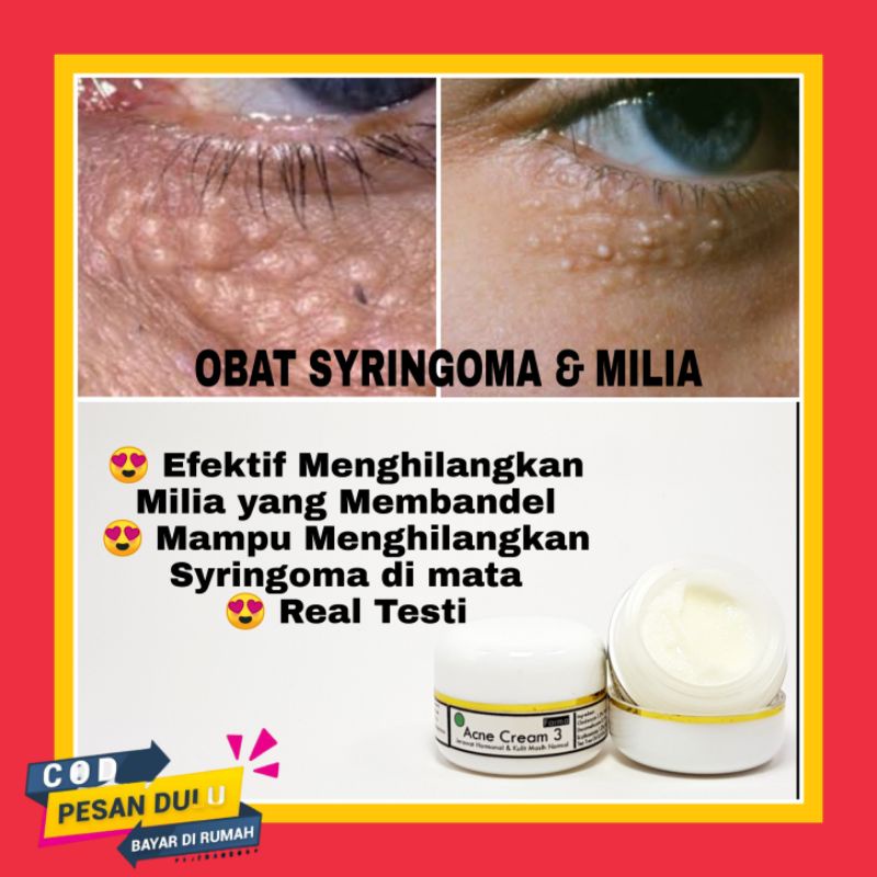 Milia Remover Penghilang Milia Penghilang Kutil Mata Original Ampuh