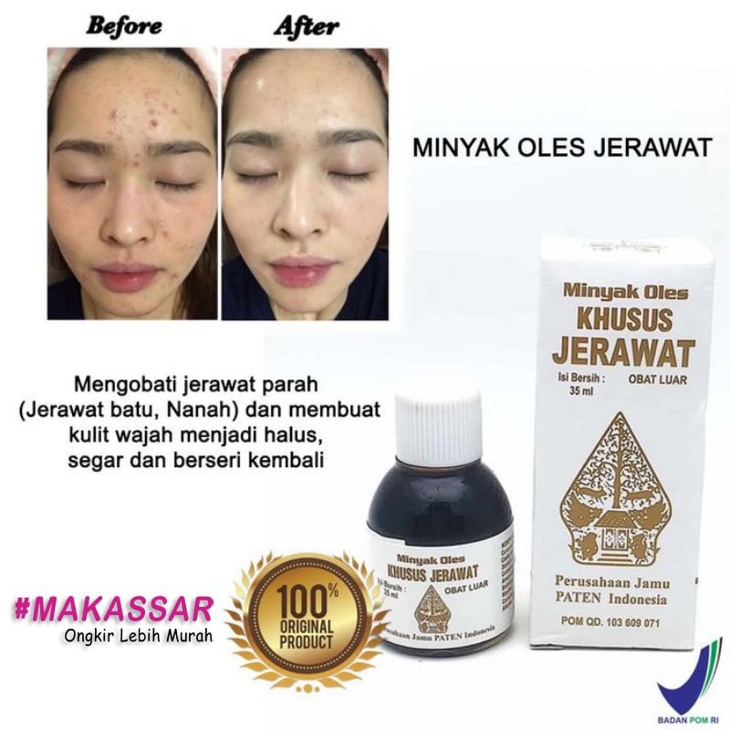 WAYANG OBAT JERAWAT ORIGINAL ASLI SANGAT AMPUH MENGOBATI JERAWAT / MINYAK OLES KHUSUS JERAWAT